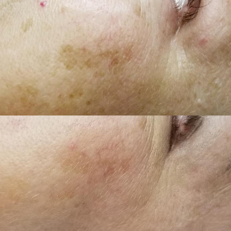 Before and after image of a photofacial treatment for discolouration on the face.