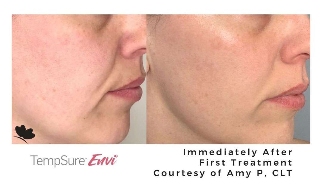 tempsure before and after treatment results