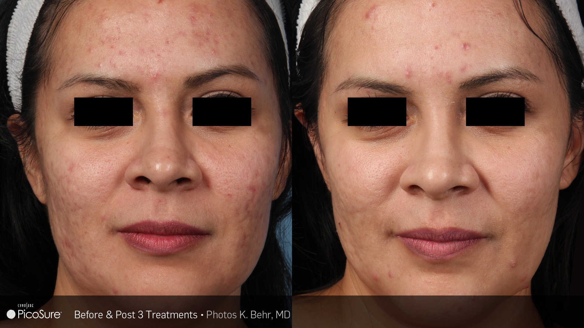 picosure treatment on acne scar showing entire face.