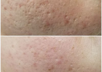 Before and 1 after microneedling treatment