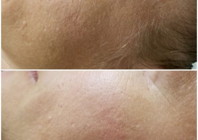 before and after results after one microneedling treatment