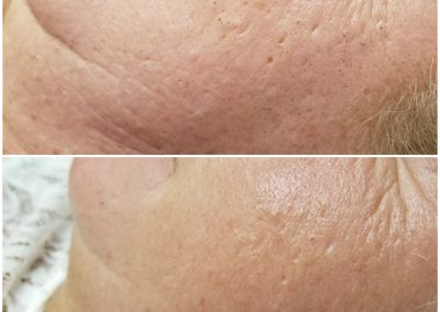 Before and after 2 treatments, 4 weeks apart