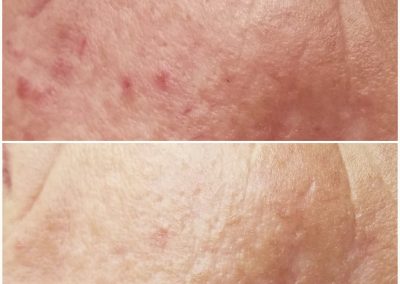 microneedling service before and after acne treatment results