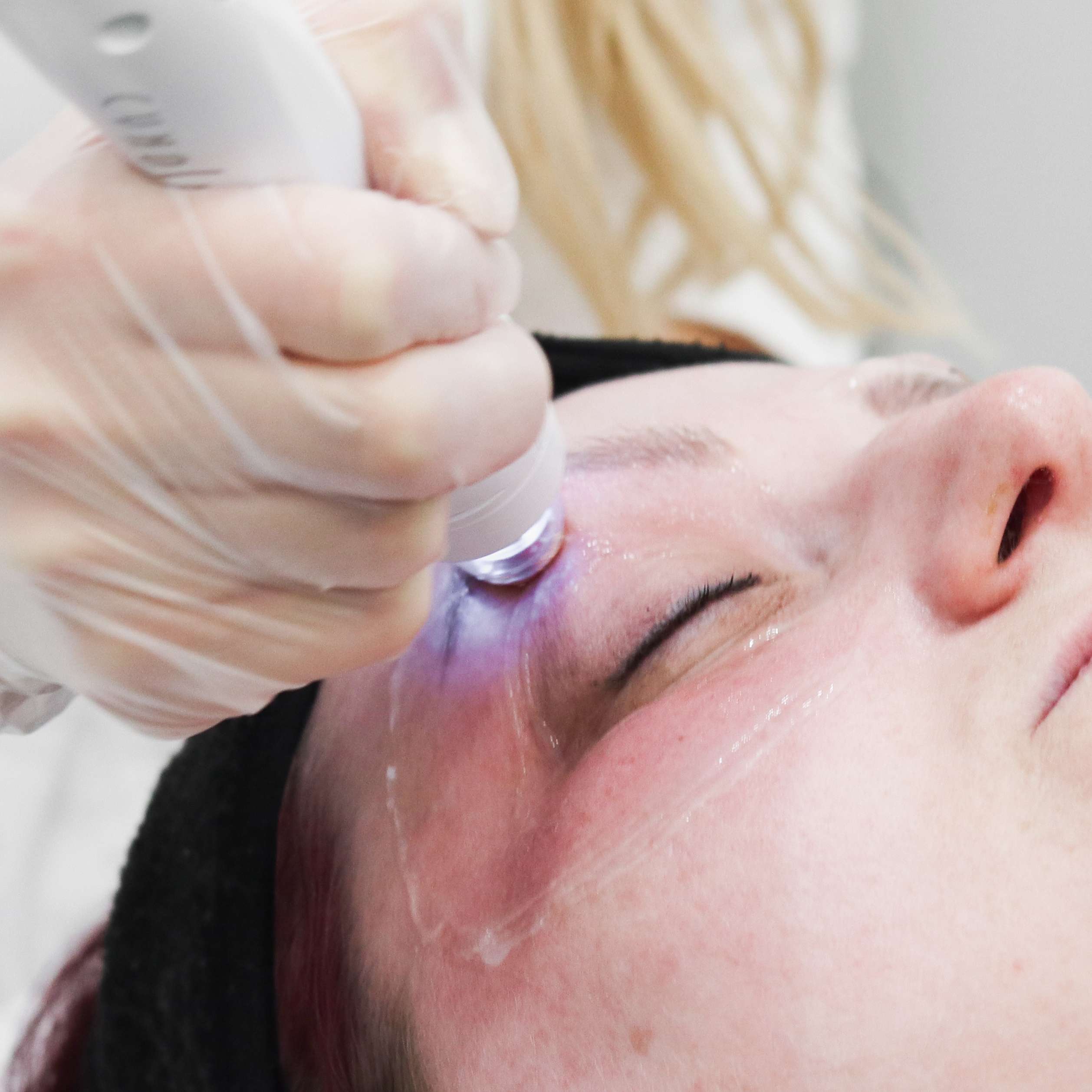 TempSure Envi Skin Tightening Eye Treatment