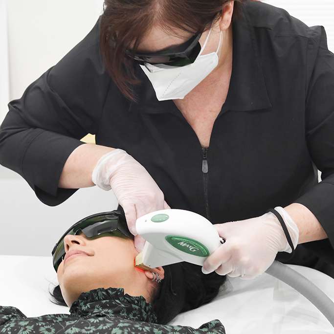 photofacial laser treatment on client