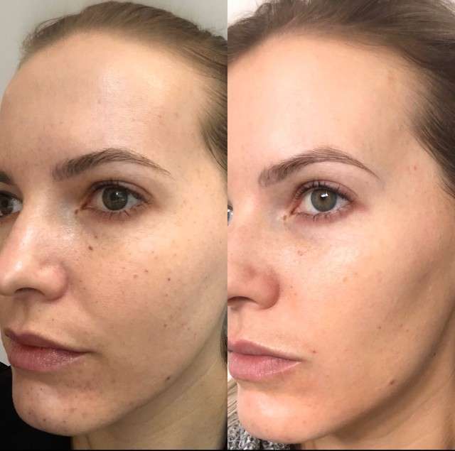 beauty booster before and after results