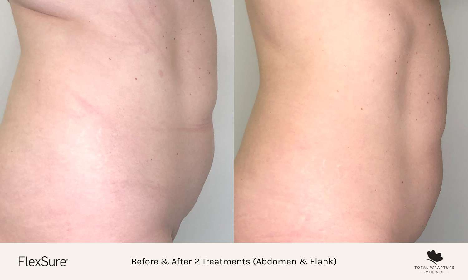 Before and after comparison of two flexsure treatments on abdomen and flanks