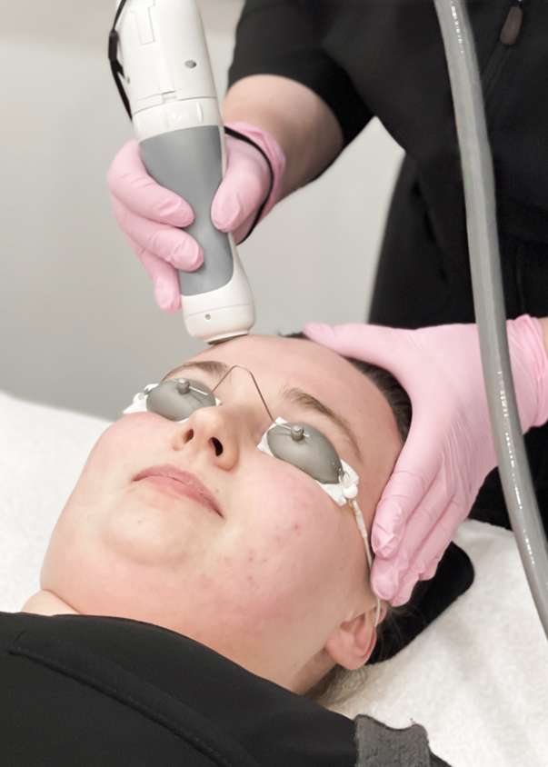 woman receiving fractional laser treatment on face