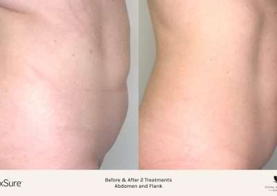 Before and after results of a FlexSure abdomen and flank treatment
