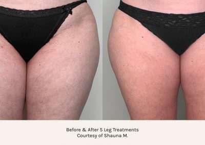 Before and after results of a body contouring treatment