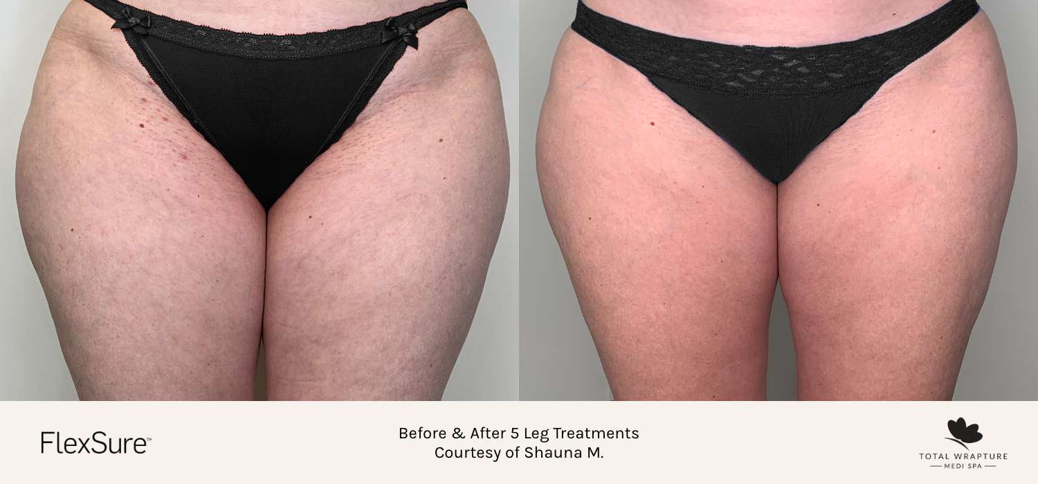 Before and after results of a body contouring treatment