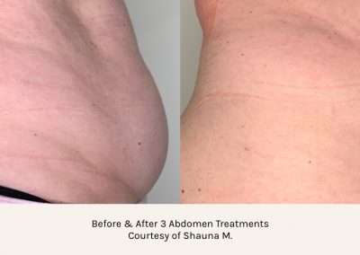 Before and after results of an abdomen body contouring treatment.
