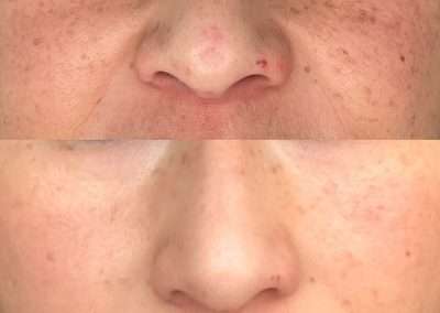 Before and after picosure results of a pigmentation treatment on the nose