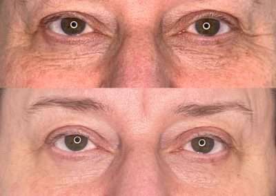 Before and after picosure results of skin revitalization treatment on the eyes