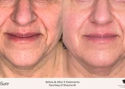 before and after picosure results of neck skin tightening treatment