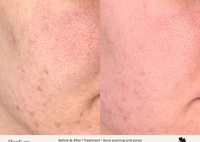 Before and after results of a PicoSure skin revitalization treatment on the cheek for acne scarring and pores