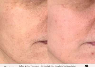 Before and after results of a PicoSure pigmentation treatment on cheek for aging and pigmentation.