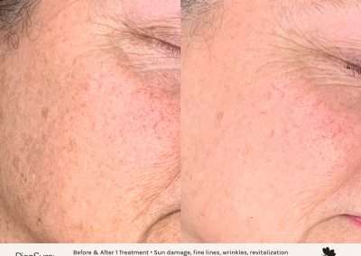 Picosure pigmentation before and after results. Skin revitalization treatment on the cheek for sun damage and fine lines.