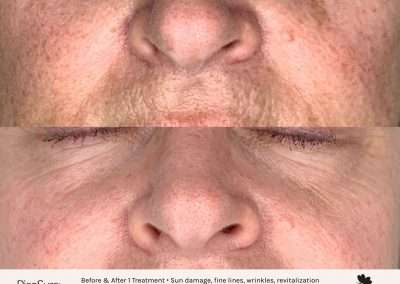 Before and after results of a PicoSure skin revitalization treatment on the nose and upper lip
