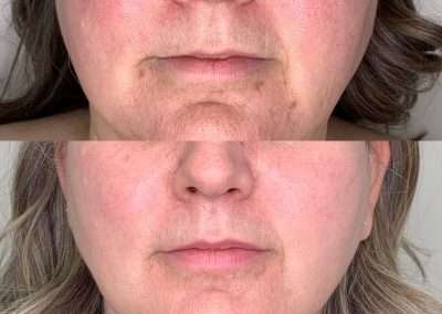 Before and after results of a PicoSure and Photofacial treatments on the lower half of face.