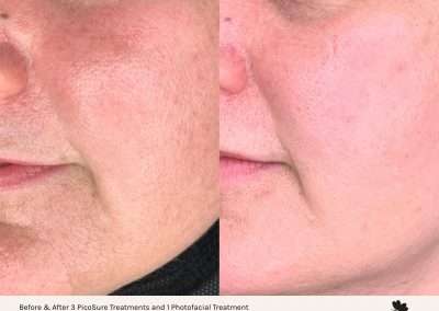 Before and after results of a PicoSure and Photofacial treatments on the cheek