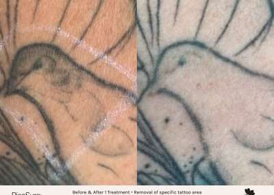Laser tattoo removal before and after results as requested by client.