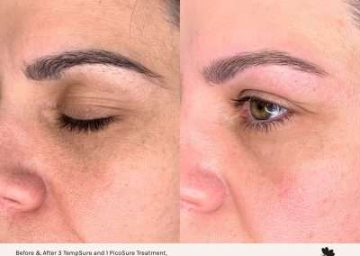 Three tempsure eye treatments and one picosure treatment. Client before and after.