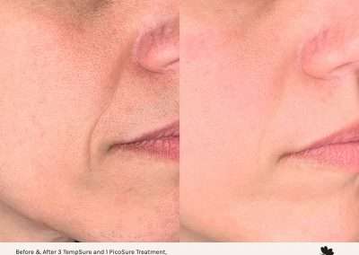 PicoSure before and after image. PicoSure after one treatment and after three tempsure treatments.
