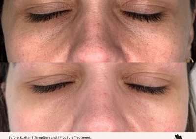 before and after image of skin rejuvenation with picosure treatment