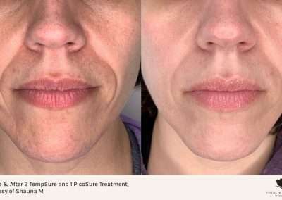 PicoSure laser face before and after. After three TempSure treatments and one PicoSure treatment.