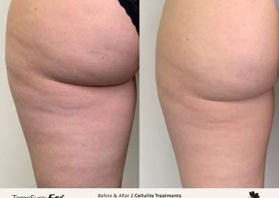 Cellulite treatment in Winnipeg for hips and buttocks.