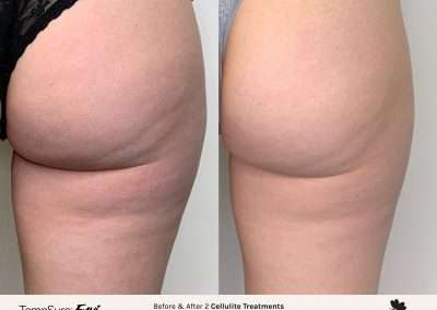 Before and after results of a TempSure Envi cellulite treatment on the buttocks.