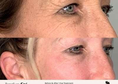 Before and after results of a TempSure Envi treatment on the eyes, targeting crows feet wrinkles in the corner of the eyes.