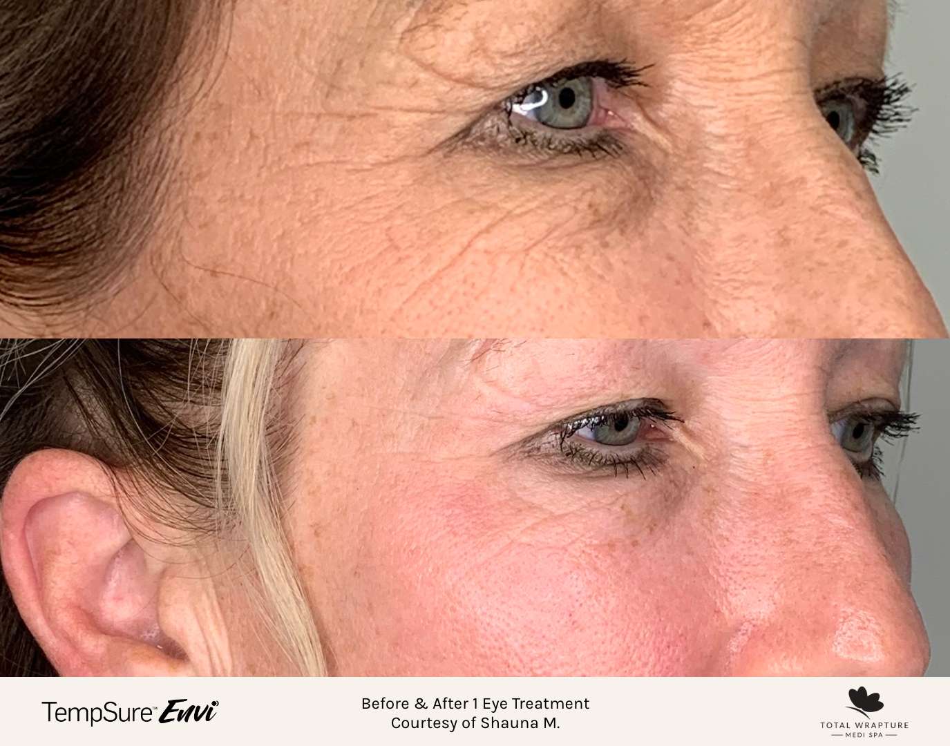Before and after results of a TempSure Envi treatment on the eyes, targeting crows feet wrinkles in the corner of the eyes.