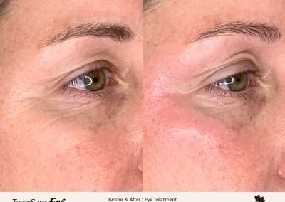 Before and after results of a TempSure Envi treatment on the eyes