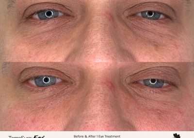 Before and after results of a TempSure Envi treatment on a male's eyes