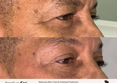 Before and after results of a TempSure Envi treatment on a male's eyes