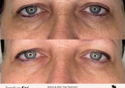 Before and after results of a TempSure Envi treatment on the eyes