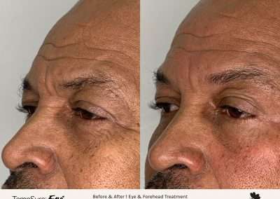 Before and after results of a TempSure Envi treatment on the eyes and forehead