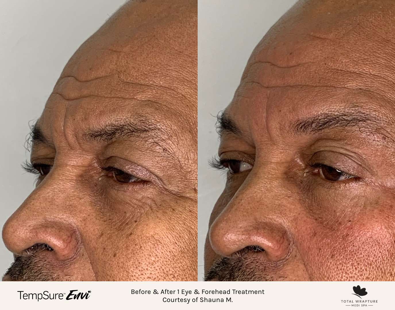 Before and after results of a TempSure Envi treatment on the eyes and forehead