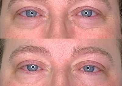 Before and after results of a TempSure Envi treatment on the eye