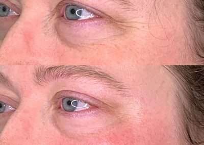 Before and after results of a TempSure Envi treatment on the eyes