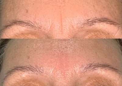 Before and after results of a TempSure Envi treatment on the forehead