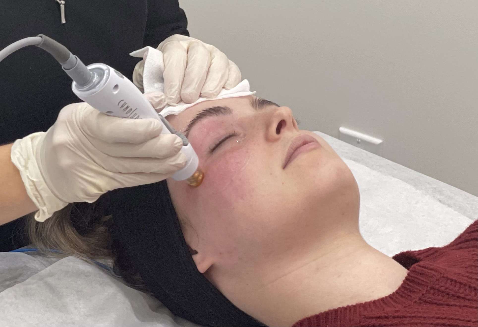 tempsure envi skin tightening