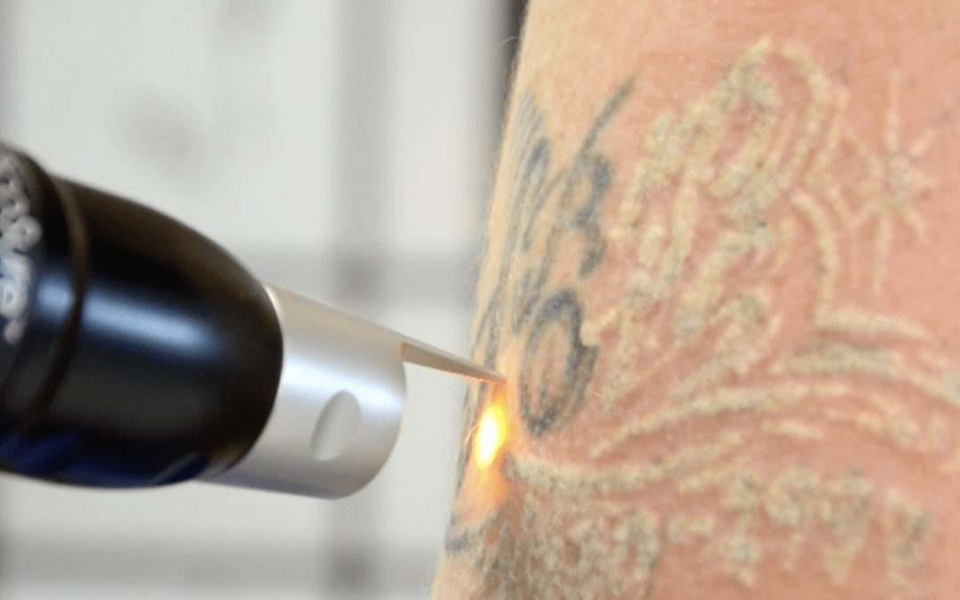 tattoo removal on a black inked tattoo on arm