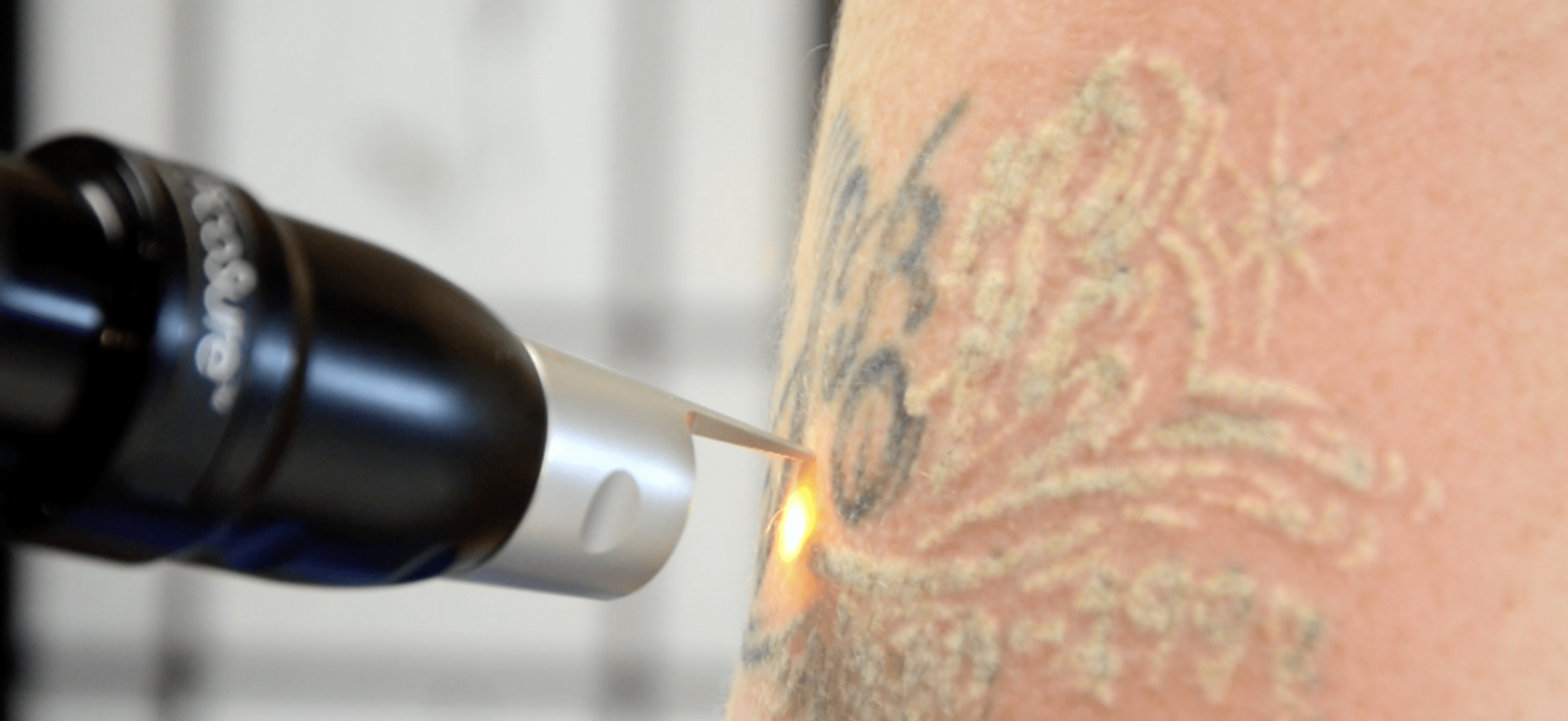 tattoo removal on a black inked tattoo on arm