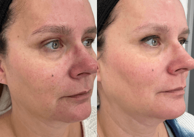 Before and after three for me treatment for pigmentation and discolouration.