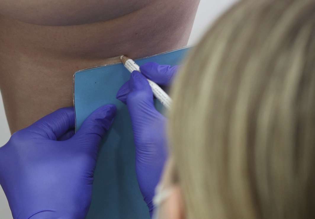 cellulite treatment on the leg