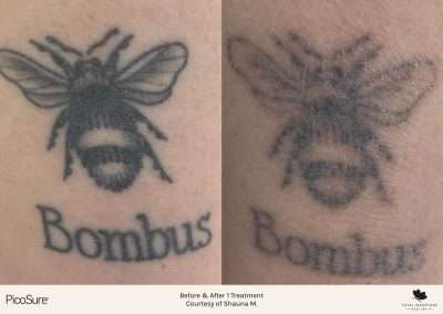 Laser tattoo removal pictures after one treatment on a bee tattoo.