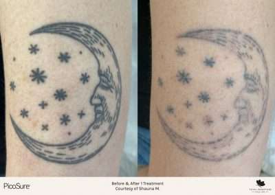 Result of tattoo removal. PicoSure tattoo removal before and after.